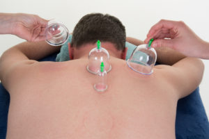 cupping