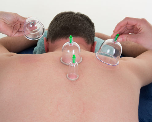 how cupping can help your performance